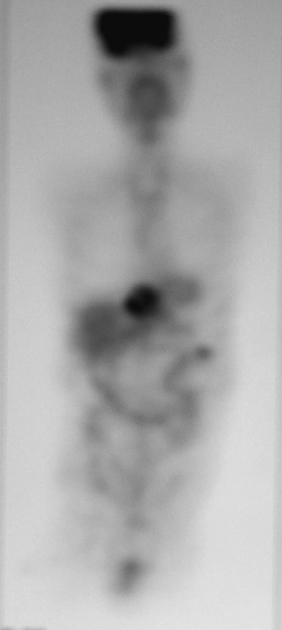 Cáncer de duodeno: causas, síntomas, diagnóstico y tratamiento - Dónde hace metástasis el cáncer de duodeno cancer duodeno - Dónde hace metástasis el cáncer de duodeno