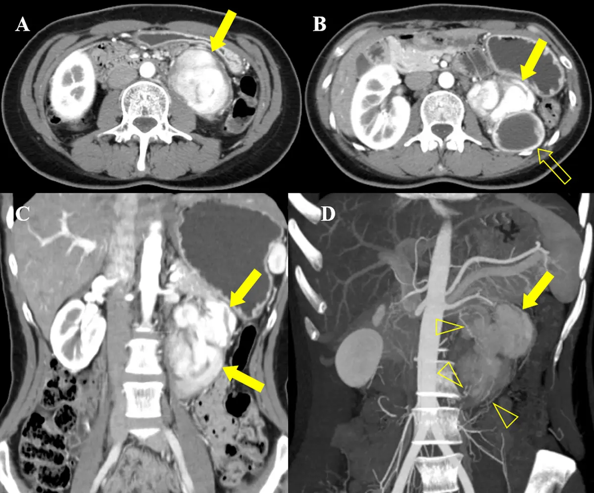 Tumor Retroperitoneal: Un Reto para la Salud - Dónde se encuentra el retroperitoneo tumor retroperitoneal - Dónde se encuentra el retroperitoneo