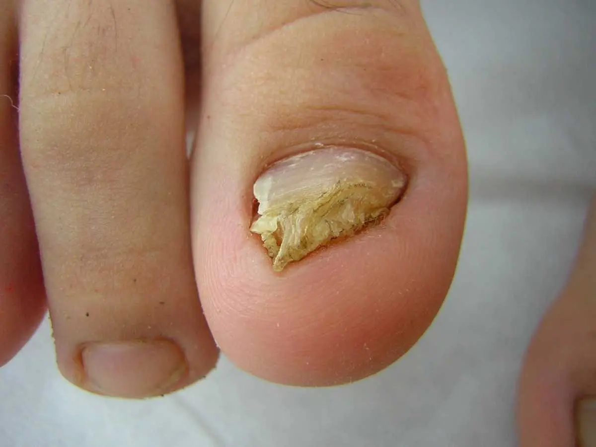 Uñas y Diabetes: Una Relación Importante - La diabetes afecta las uñas uñas diabetes - La diabetes afecta las uñas