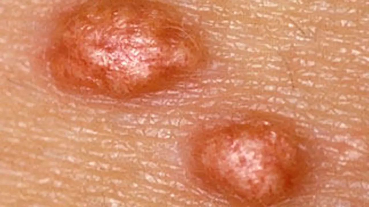 Xantomatosis Eruptiva: Causas, Síntomas y Tratamiento - La xantomatosis eruptiva es contagiosa xantomatosis eruptiva - La xantomatosis eruptiva es contagiosa