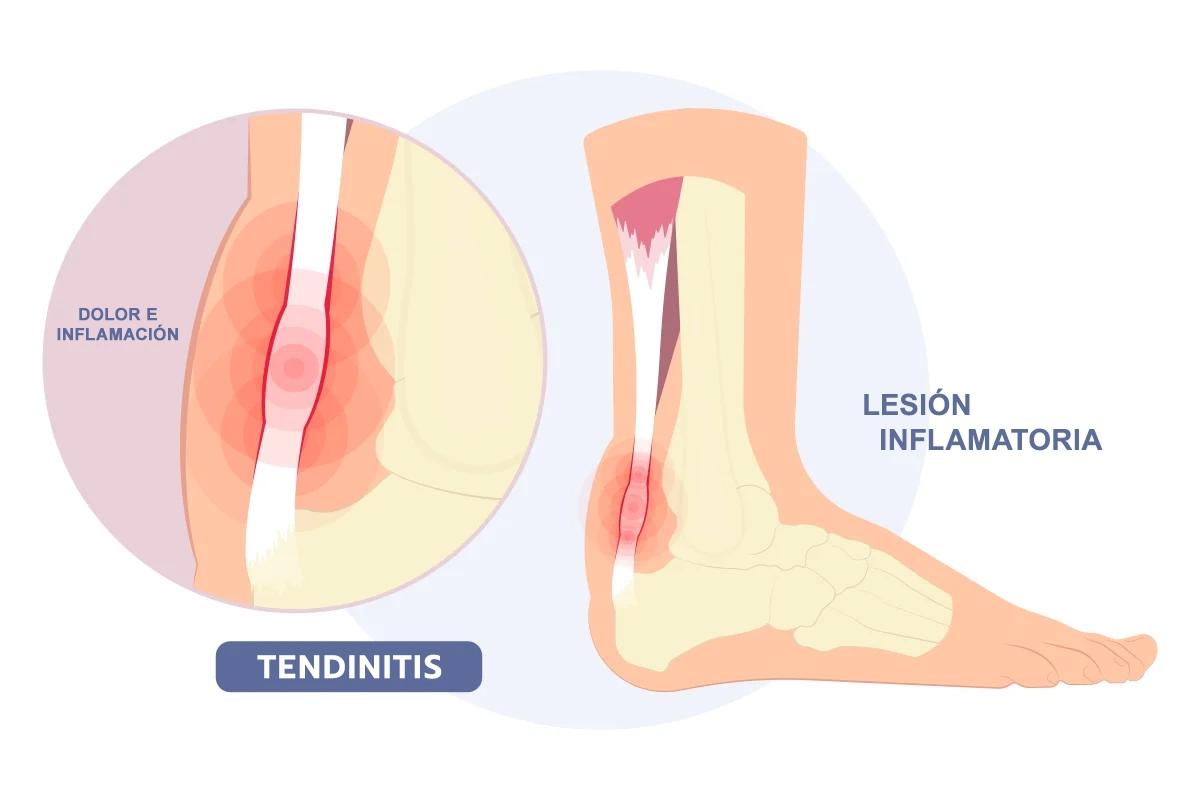 Tendinitis: Causas, Síntomas, Tratamiento y Prevención - Por qué da la tendinitis que es tendinitis - Por qué da la tendinitis