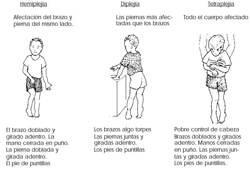 Parálisis Cerebral Espástica: Causas, Síntomas, Diagnóstico y Tratamiento - Por qué la parálisis cerebral causa espasticidad paralisis cerebral espastica - Por qué la parálisis cerebral causa espasticidad