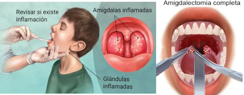 Dolor de garganta por frío: causas, duración y remedios - Por qué me duele la garganta con el aire frío dolor de garganta por frio - Por qué me duele la garganta con el aire frío