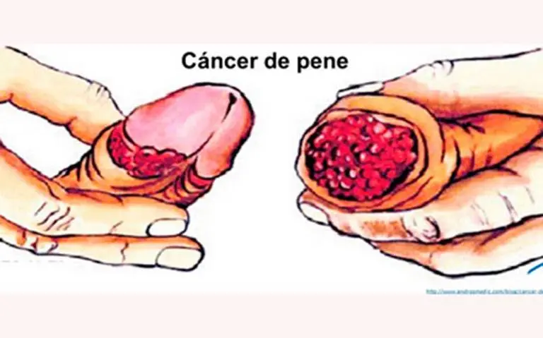 Alergia al Preservativo: Síntomas, Causas y Tratamiento - Por qué me irrita el condón alergia al preservativo - Por qué me irrita el condón