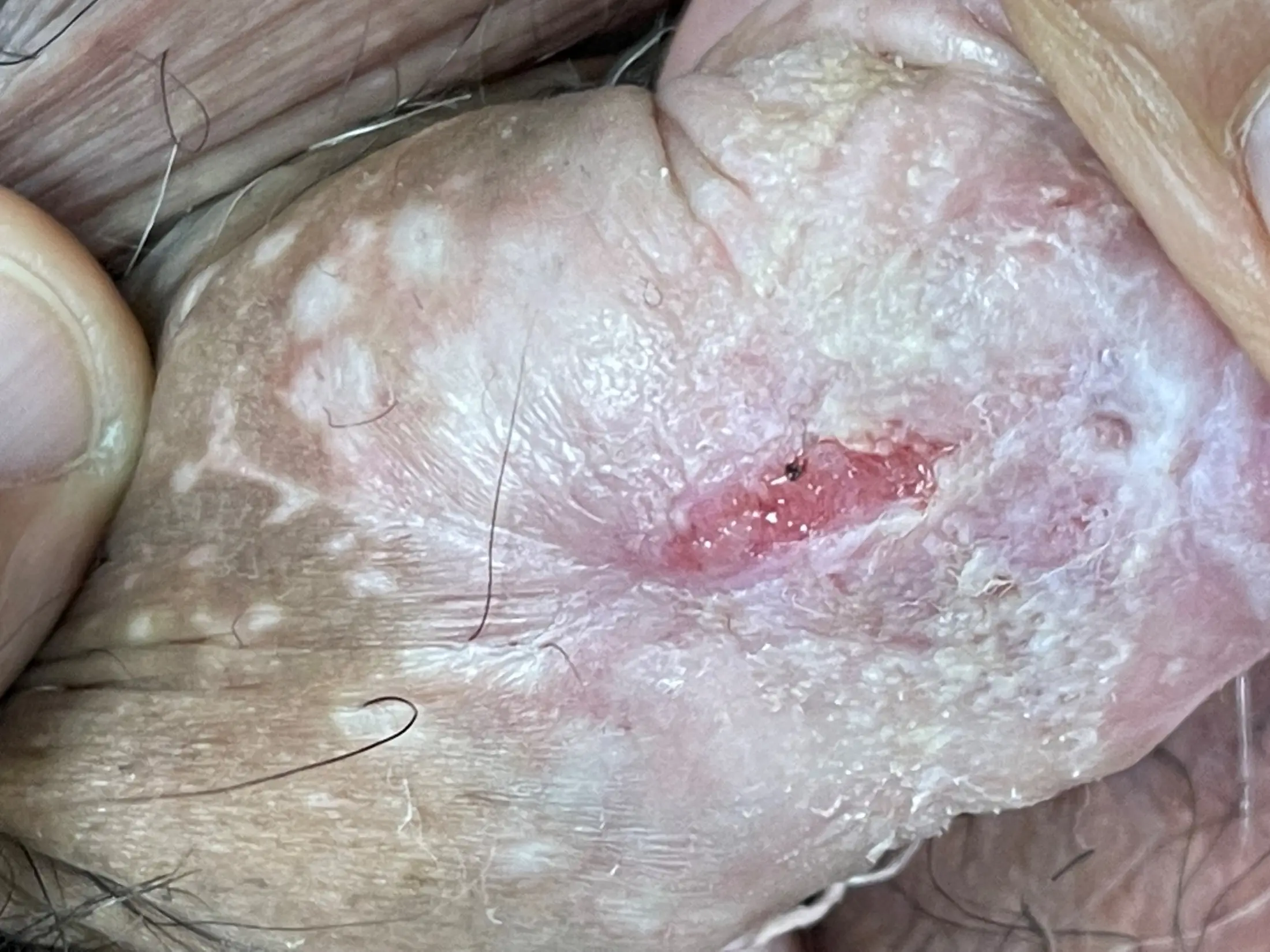 Liquen Escleroso: Causas, Síntomas, Diagnóstico y Tratamiento - Por qué sale el liquen escleroso liquen escleroso - Por qué sale el liquen escleroso