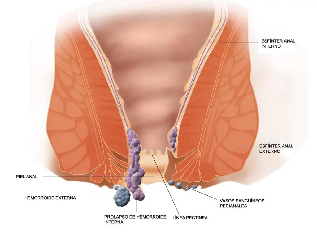 Cómo Curar las Hemorroides Externas: Guía Completa para Aliviar el Dolor y la Hinchazón - Por qué salen las hemorroides externas como curar las hemorroides externas - Por qué salen las hemorroides externas