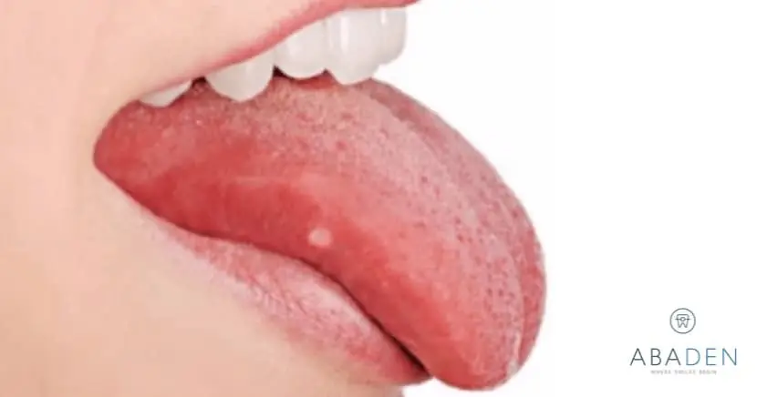 Llagas en la Punta de la Lengua: Causas, Tratamientos y Prevención - Por qué salen llagas en la punta de la lengua llagas en la punta de la lengua - Por qué salen llagas en la punta de la lengua