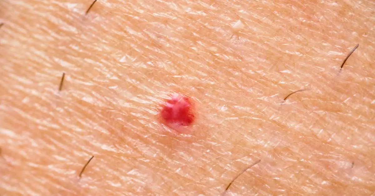 Hemangioma en Adultos: ¿Qué es, Causas, Síntomas y Tratamiento? - Por qué salen los hemangiomas hemangioma en adultos - Por qué salen los hemangiomas