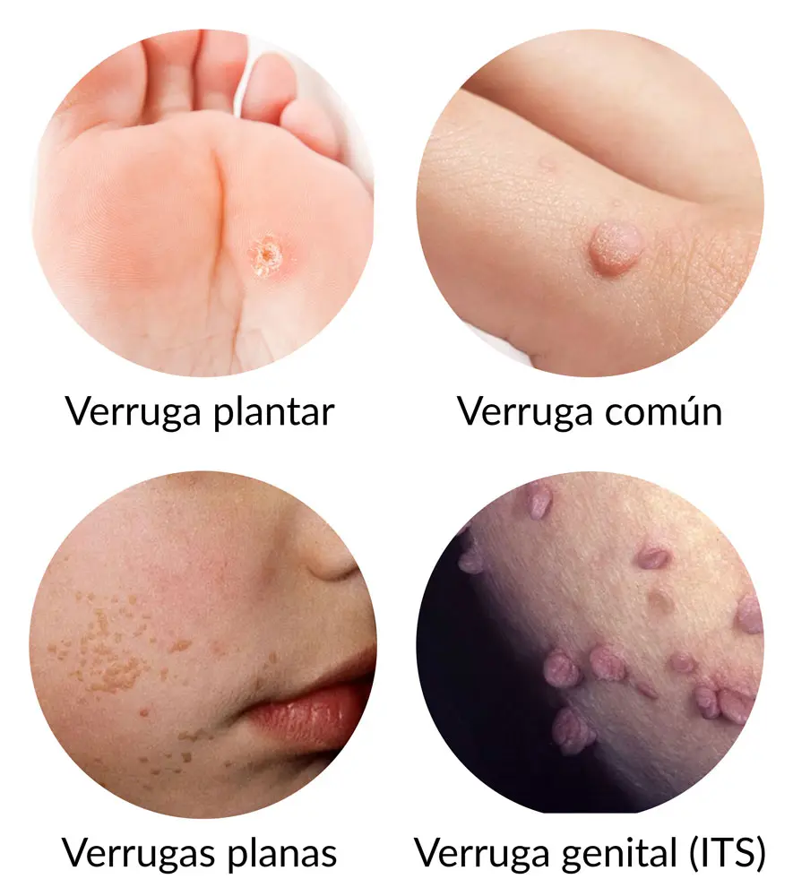 Cómo Eliminar Verrugas: Guía Completa para su Tratamiento - Por qué salen verrugas como eliminar verrugas - Por qué salen verrugas