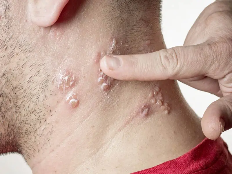 Culebrilla: Causas, Síntomas, Tratamiento y Prevención - Por qué se da la culebrilla como curar la culebrilla - Por qué se da la culebrilla