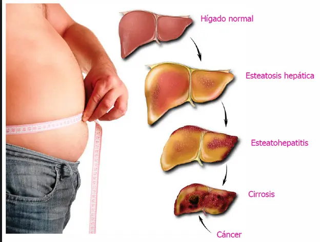 Hepatomegalia: Causas, síntomas y tratamiento - Por qué se da la hepatomegalia higado agrandado - Por qué se da la hepatomegalia