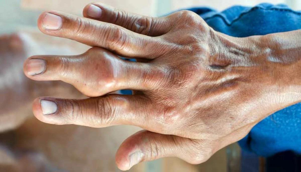 Ácido Úrico Alto: Síntomas, Causas y Tratamiento - Por qué se sube el ácido úrico acido urico alto sintomas - Por qué se sube el ácido úrico
