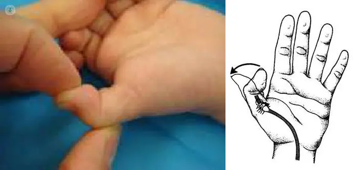 Dedo en gatillo: Causas, síntomas y tratamiento - Por qué se traba el dedo pulgar dedo en gatillo pulgar - Por qué se traba el dedo pulgar