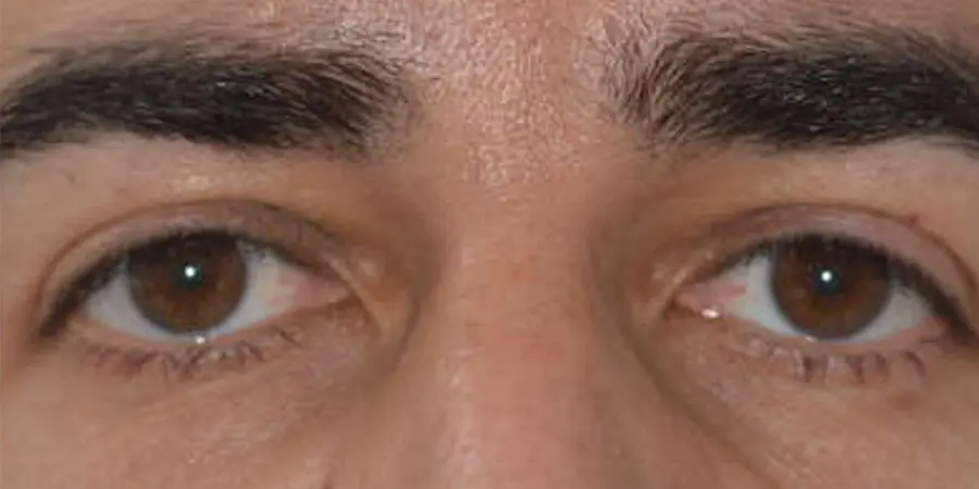 Ojos Caídos en Hombres: Causas, Síntomas y Tratamientos - Por qué tengo el ojo caído ojos caídos hombres - Por qué tengo el ojo caído