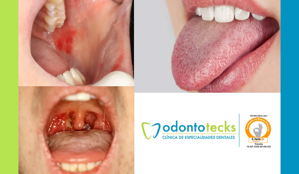 Boca Seca y Pastosa: Causas, Síntomas y Remedios - Por qué tengo la boca seca y pastosa boca seca y pastosa - Por qué tengo la boca seca y pastosa
