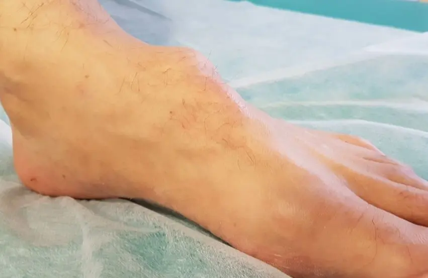 Dolor en el pie: Causas, síntomas y tratamientos - Por qué tengo un hueso salido en el pie sobre hueso en el pie - Por qué tengo un hueso salido en el pie