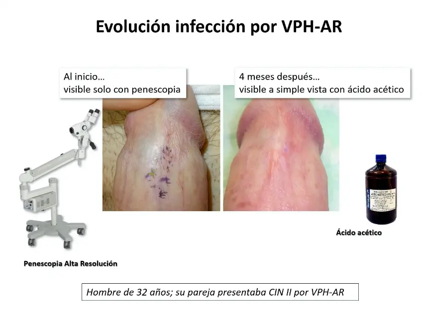 Imiquimod para el VPH: Tratamiento, Eficacia y Efectos Secundarios - Puede el imiquimod curar el VPH imiquimod vph - Puede el imiquimod curar el VPH