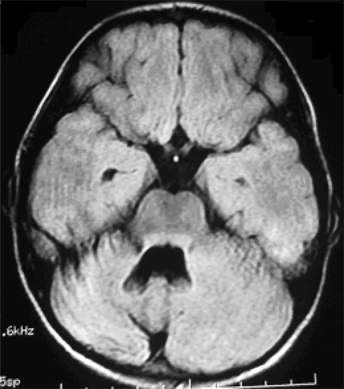 Cerebelitis en niños: causas, síntomas y tratamiento - Puede la cerebelitis causar convulsiones cerebelitis - Puede la cerebelitis causar convulsiones