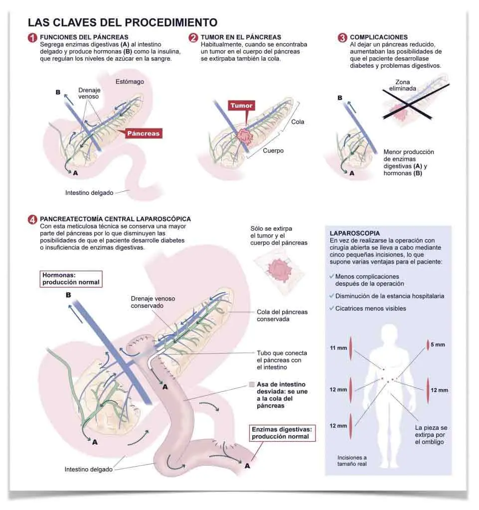 Pancreatectomía: Dieta y Alimentación Después de la Cirugía - Qué alimentos tendrá que evitar el paciente después de la pancreatectomía pancreatectomía - Qué alimentos tendrá que evitar el paciente después de la pancreatectomía