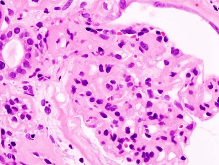 Glomerulonefritis: Causas, Síntomas y Tratamiento - Qué bacteria causa la glomerulonefritis glomerulonefrosis - Qué bacteria causa la glomerulonefritis