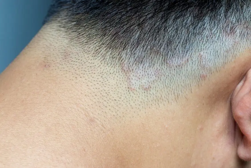 Infecciones en el cuero cabelludo: causas, síntomas y tratamientos - Qué bacterias hay en el cuero cabelludo infecciones en el cuero cabelludo - Qué bacterias hay en el cuero cabelludo