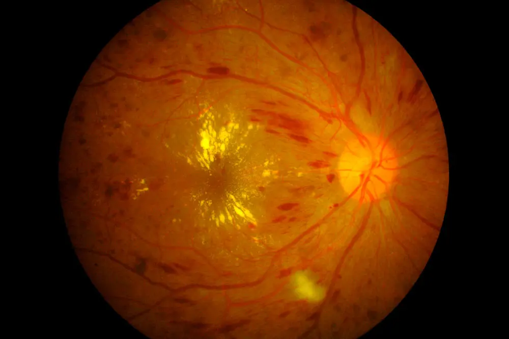 Edema Macular: Causas, Síntomas y Tratamiento - Qué causa el edema ocular edema macular - Qué causa el edema ocular