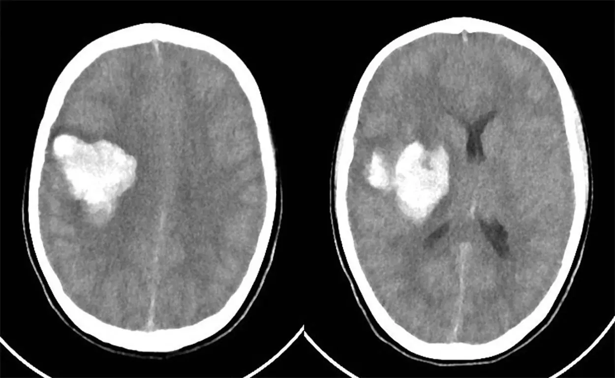 Hematoma Intraparenquimatoso: Causas, Síntomas y Tratamiento - Qué causa el hematoma intraparenquimatoso hematoma intraparenquimatoso - Qué causa el hematoma intraparenquimatoso