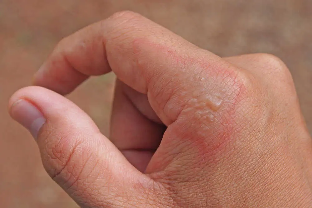 Impétigo en Adultos: Causas, Síntomas y Tratamiento - Qué causa el impétigo en adultos impetigo en adultos - Qué causa el impétigo en adultos