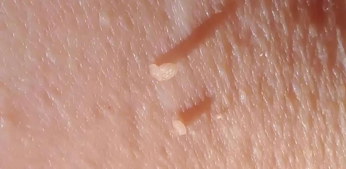 Papilomatosis Reticulada y Confluente: Un Enigma Cutáneo - Qué causa el papiloma cutáneo papiloma cutaneo - Qué causa el papiloma cutáneo