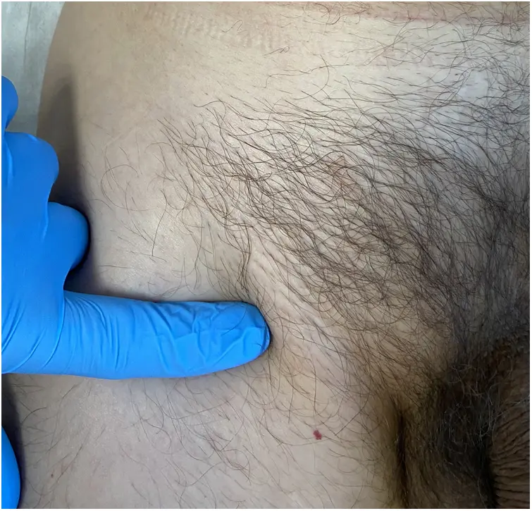 Adenopatía Inguinal: Causas, Síntomas y Tratamiento - Qué causa la adenopatía inguinal adenomegalia inguinal - Qué causa la adenopatía inguinal