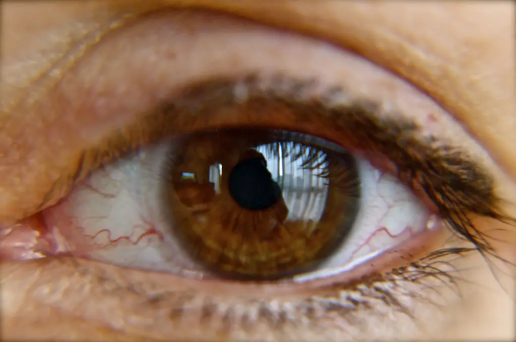 Celulitis Preseptal: Causas, Síntomas y Diagnóstico - Qué causa la celulitis en los ojos celulitis preseptal - Qué causa la celulitis en los ojos
