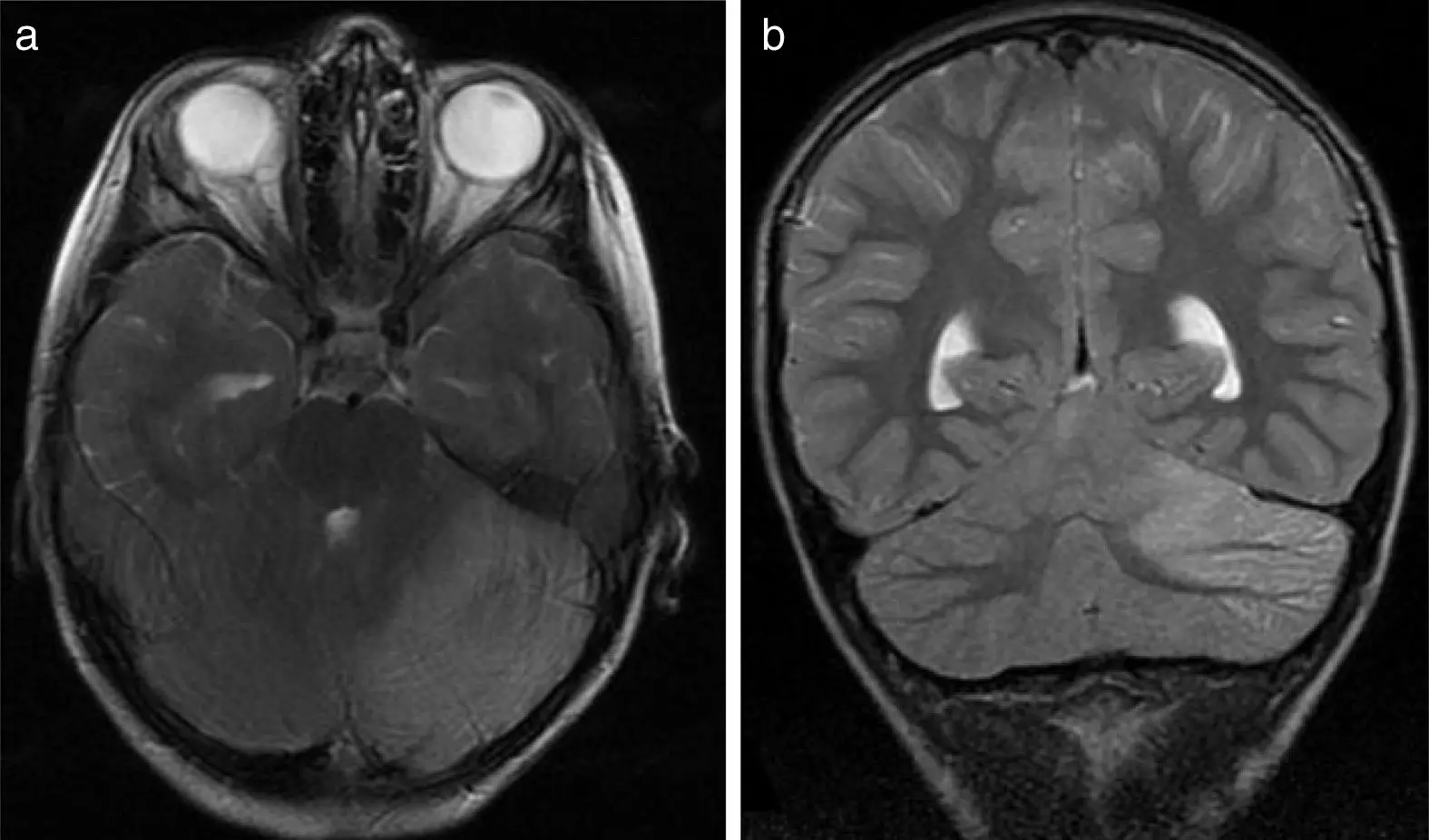 Cerebelitis en niños: causas, síntomas y tratamiento - Qué causa la cerebelitis en los niños cerebelitis - Qué causa la cerebelitis en los niños