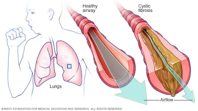 Fibrosis Pulmonar: Causas, Síntomas y Tratamiento - Qué causa la fibrosis pulmonar fibrosis quistica causas - Qué causa la fibrosis pulmonar