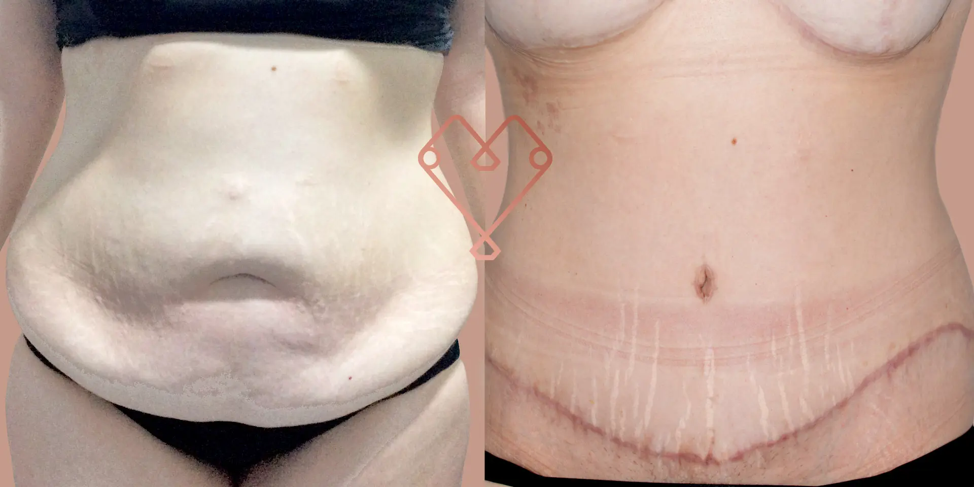 Cirugía Estética Corporal: Guía Completa para el 2023 - Qué cirugías hay para el cuerpo cirugia estetica corporal - Qué cirugías hay para el cuerpo