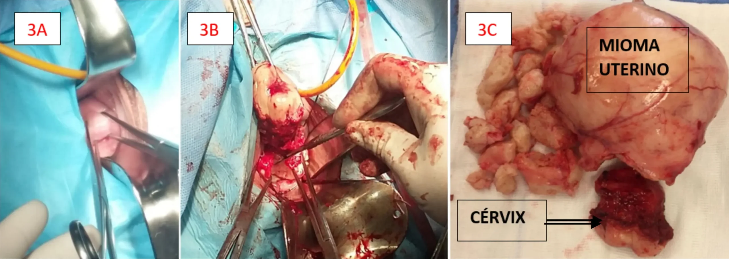Histerectomía por Miomas: ¿Qué implica esta cirugía y cuáles son sus riesgos? - Qué consecuencias trae extraer miomas uterinos histerectomia por miomas - Qué consecuencias trae extraer miomas uterinos