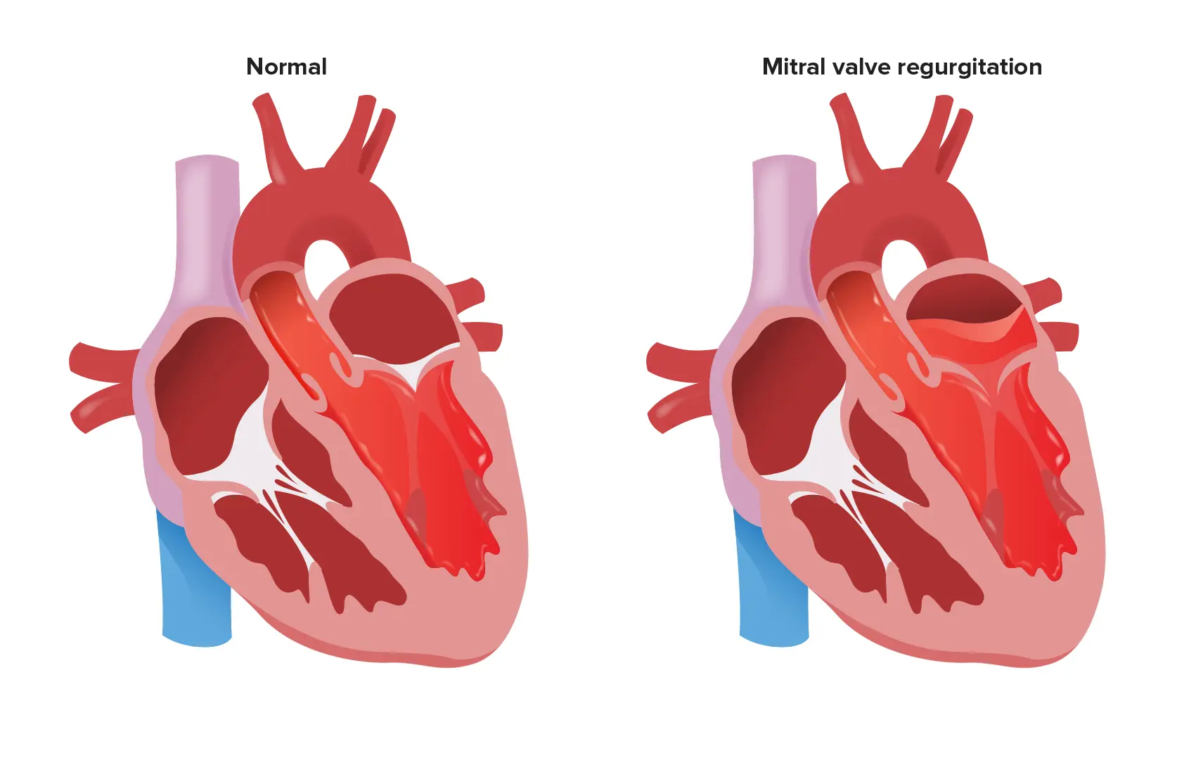 Regurgitación Mitral: Causas, Síntomas y Tratamiento - Qué consecuencias trae la válvula mitral regurgitacion mitral - Qué consecuencias trae la válvula mitral