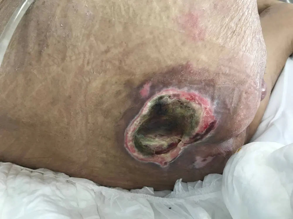 Cómo curar las escaras en la piel: guía completa para el cuidado de las úlceras por presión - Qué crema es buena para curar las escaras escaras en la piel - Qué crema es buena para curar las escaras