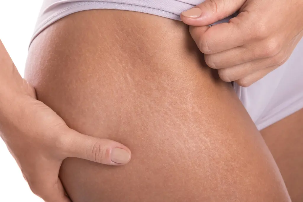 Cómo eliminar las estrías blancas: guía completa - Qué crema es buena para eliminar las estrías como sacar las estrias - Qué crema es buena para eliminar las estrías