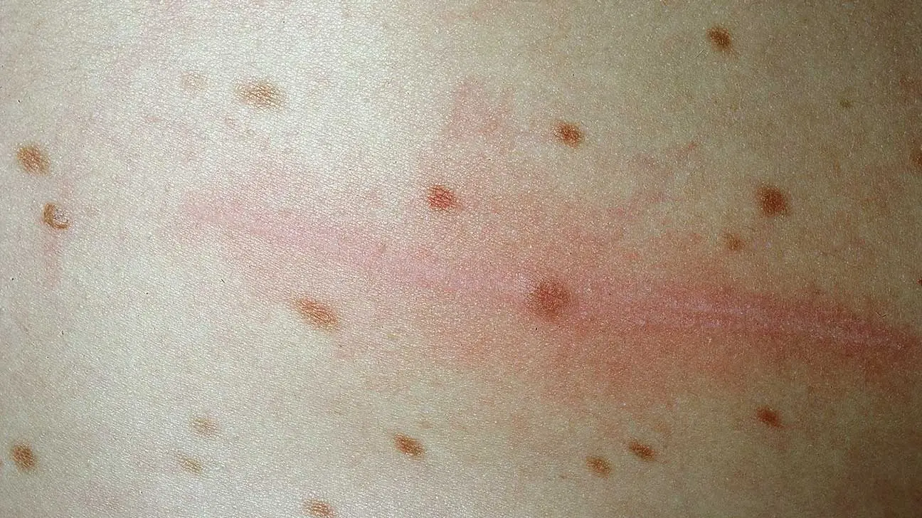Urticaria Pigmentosa: Una Guía Completa para Padres e Hijos - Qué crema es buena para la urticaria pigmentosa urticaria pigmentosa - Qué crema es buena para la urticaria pigmentosa