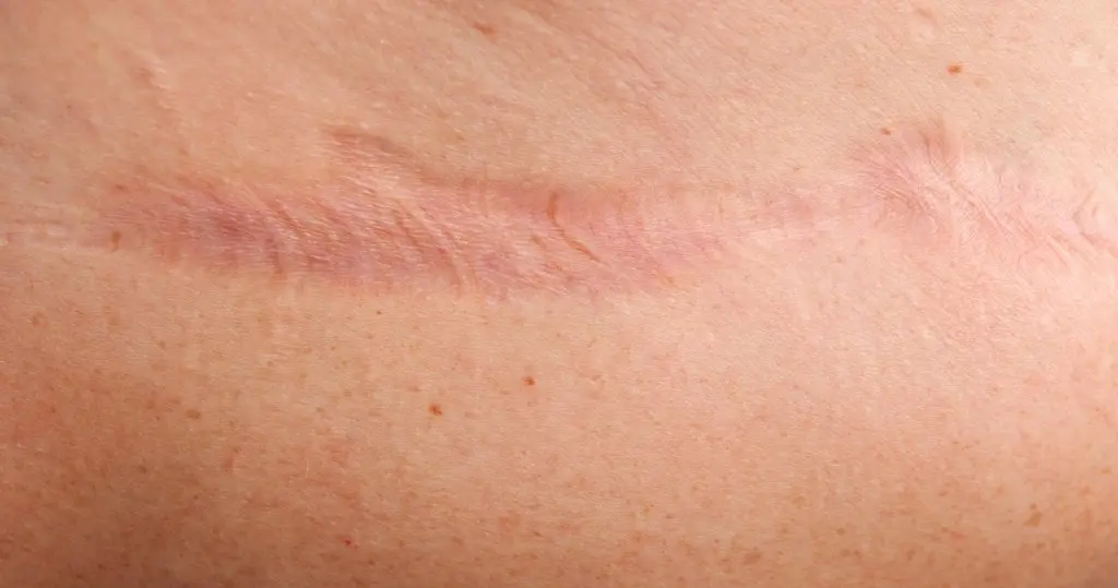 Tratamiento de Queloides: Todo lo que Necesitas Saber - Qué crema es buena para queloides queloide tratamiento - Qué crema es buena para queloides