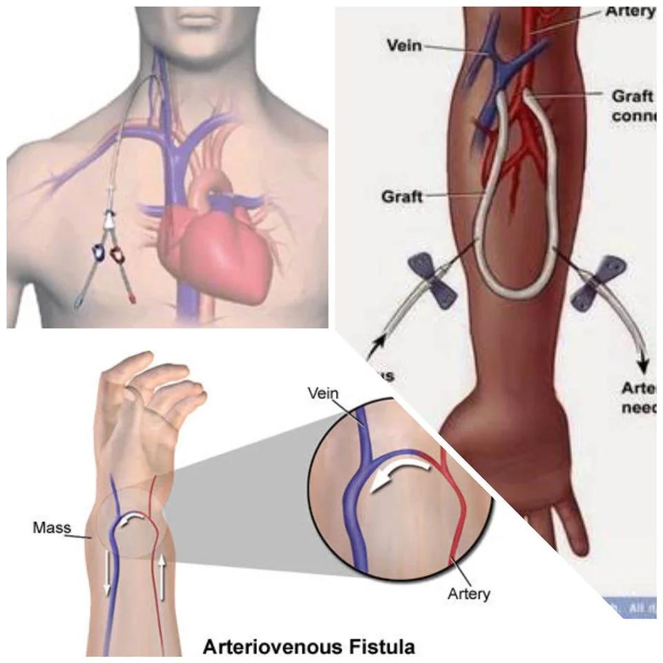Fístula Arteriovenosa para Diálisis: Duración y Comparación con Catéteres - Qué cuidados debe tener con una fístula arteriovenosa fistula para dialisis - Qué cuidados debe tener con una fístula arteriovenosa