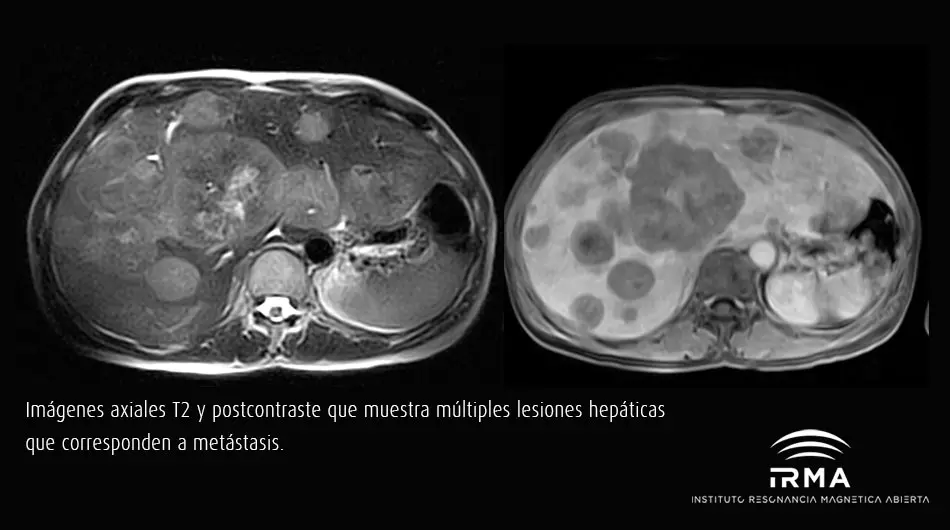 Resonancia de Abdomen: Una Guía Completa para Entender la Prueba - Qué detecta una resonancia de abdomen resonancia de abdomen - Qué detecta una resonancia de abdomen