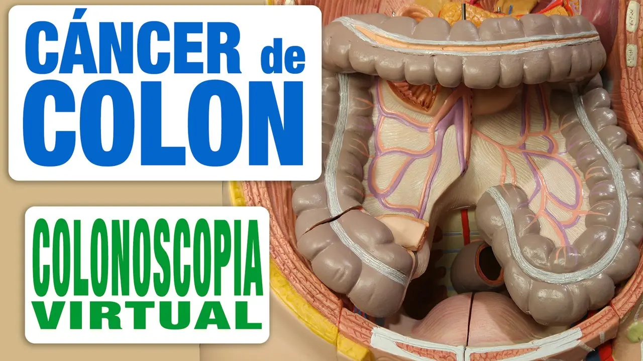 Colonoscopia Virtual: Preparación, Procedimiento y Resultados - Qué diferencia hay entre colonoscopia y colonoscopia virtual colonoscopia virtual preparacion - Qué diferencia hay entre colonoscopia y colonoscopia virtual