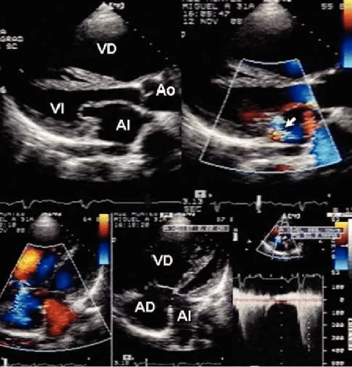 ecocardiografia bidimensional - Qué diferencia hay entre un ecocardiograma y una ecocardiografía