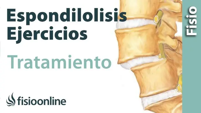 tratamiento para la espondilosis - Qué ejercicios puedo hacer si tengo espondilosis