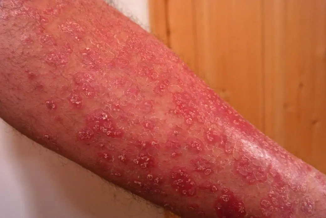 psoriasis biodescodificacion - Qué emoción se somatiza en la piel