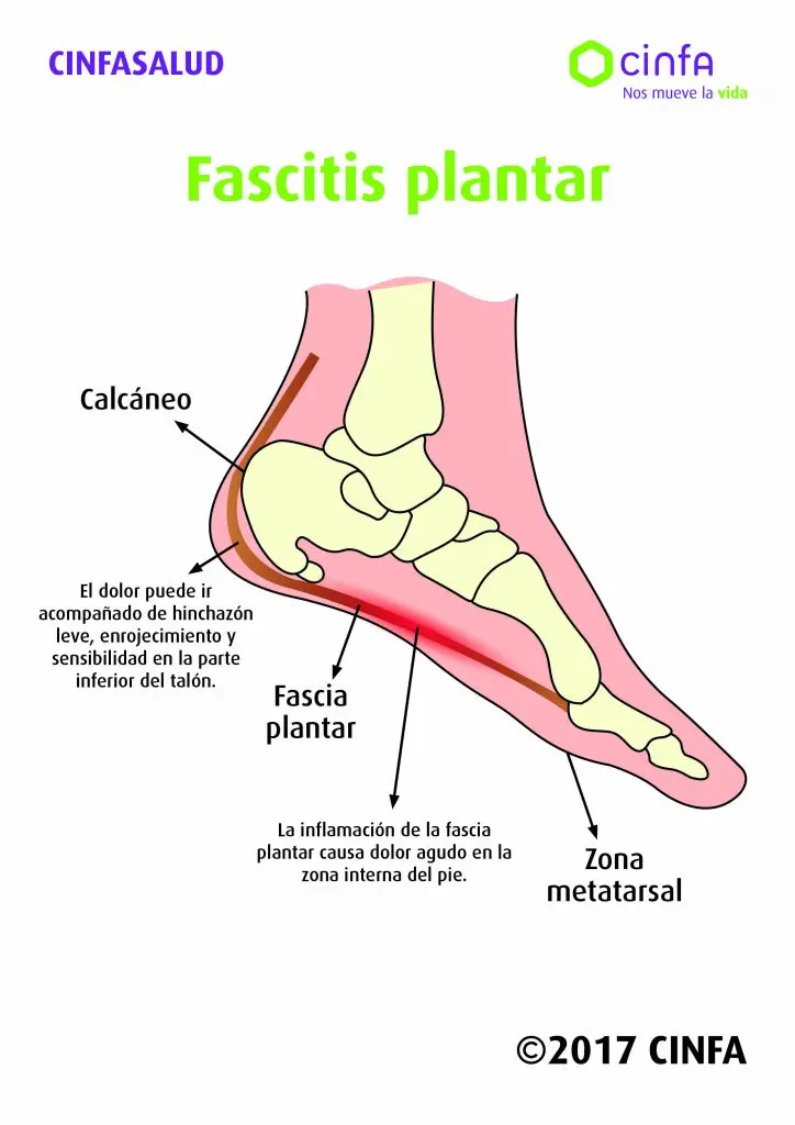 Fascitis Plantar: Causas, Tratamiento y Prevención - Qué empeora la fascitis plantar dolor en la planta del pie - Qué empeora la fascitis plantar