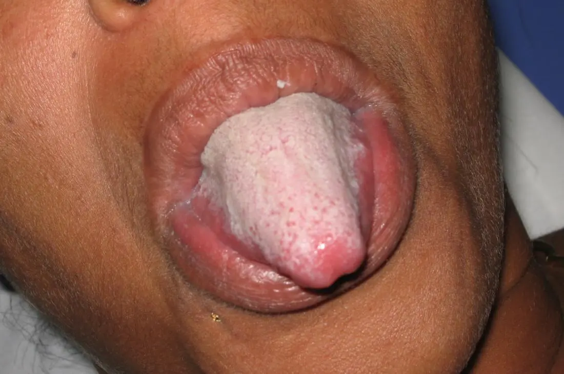 Lengua Blanca: Causas, Síntomas y Soluciones - Qué enfermedad del hígado causa lengua blanca lengua blanca y dolor de garganta - Qué enfermedad del hígado causa lengua blanca