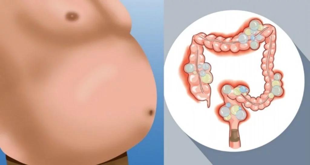 Meteorismo Intestinal: Causas, Síntomas Y Tratamiento | Doctor Online