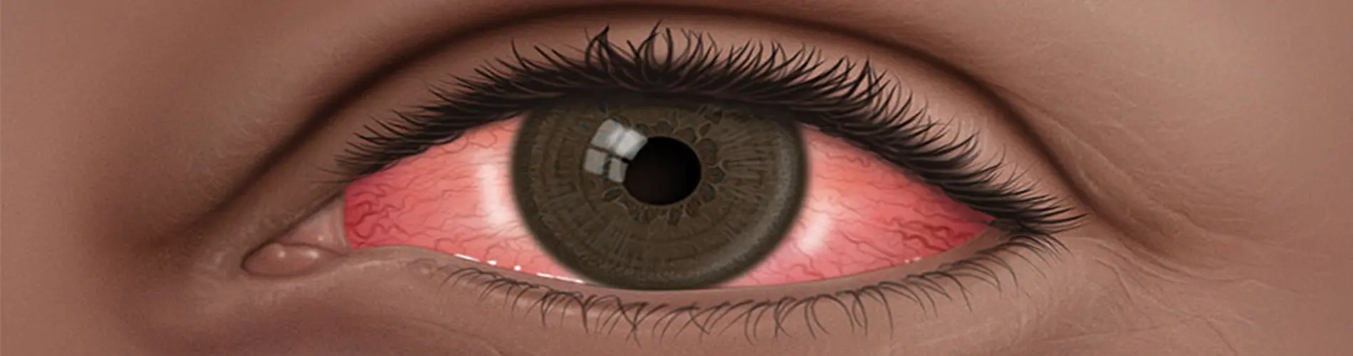 Dolor de Ojos al Moverlos: Causas, Tipos y Cuándo Consultar - Qué enfermedad te hace doler los ojos dolor de ojos al moverlos - Qué enfermedad te hace doler los ojos